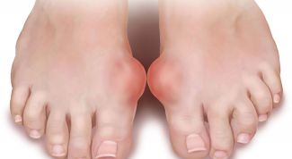 Бурсит большого пальца ноги: лечение, профилактика