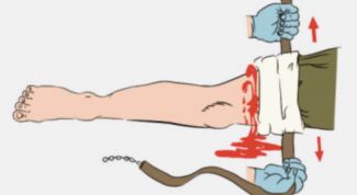 Кровоостанавливающий жгут: техника наложения 