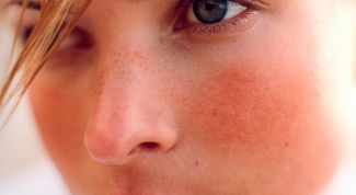 Розацеа на лице: причины, симптомы, диета и лечение