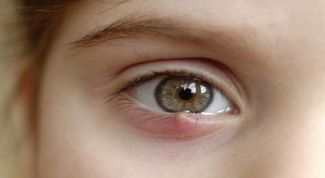 Как лечить ячмень на глазу у ребенка