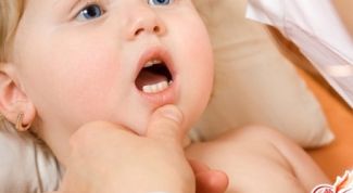 Как лечить молочницу во рту у ребенка в 2 месяца