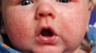 Картинка по теме - как лечить диатез