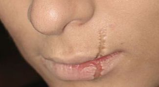 Картинка по теме - как удалить шрам