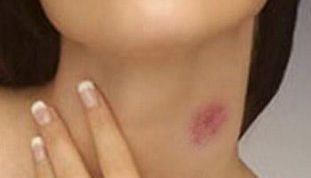 Картинка по теме - как убрать засос