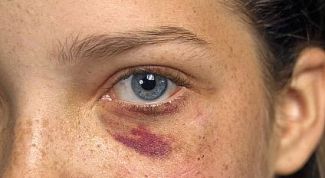 Картинка по теме - как избавиться от фингала