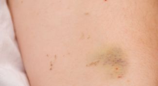 Картинка по теме - как избавиться быстро от синяков