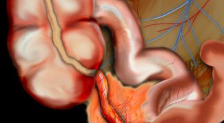 Картинка по теме - как распознать аппендицит
