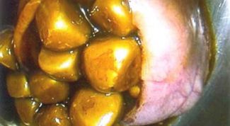 Картинка по теме - как вывести камни в желчном пузыре