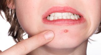 Картинка по теме - как убрать прыщи за день