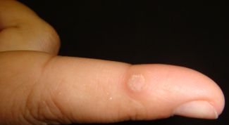 Картинка по теме - как избавиться от бородавки на руке