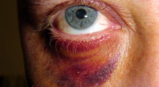 Картинка по теме - как убрать синяк под глазом