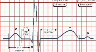 Картинка по теме - как читать кардиограмму