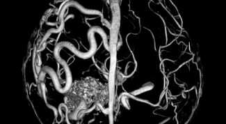Картинка по теме - как расширить сосуды головного мозга