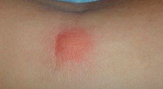 Картинка по теме - как лечить крапивницу народными средствами