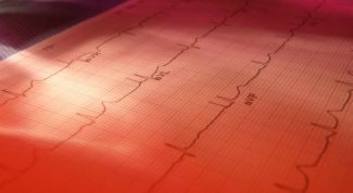 Картинка по теме - как расшифровать экг