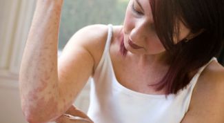 Картинка по теме - как лечить экзему народными средствами