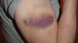 Картинка по теме - как удалить быстро синяк