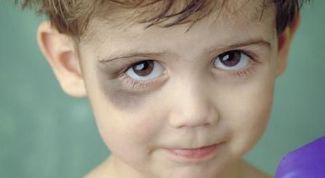 Картинка по теме - как вылечить фингал