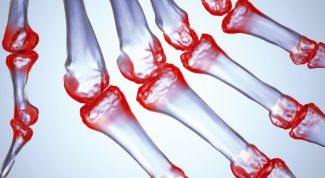 Картинка по теме - как вылечить ревматоидный артрит