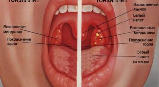 Картинка по теме - как лечить першение в горле