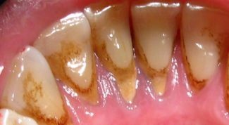 Картинка по теме - как избавиться от камня на зубах