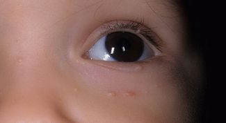 Картинка по теме - как вылечить контагиозный моллюск