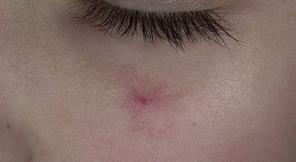 Картинка по теме - как избавиться от сосудистых звездочек на лице