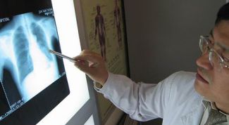 Картинка по теме - как определить рак легких