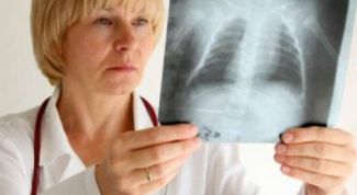 Картинка по теме - как отличить бронхит от пневмонии