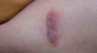 Картинка по теме - как избавиться от следа от ожога