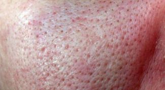 Картинка по теме - как убрать расширенные поры на лице