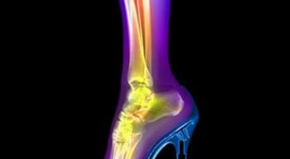 Картинка по теме - как лечить трещину кости