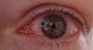 Картинка по теме - как лечить вирусный коньюктивит