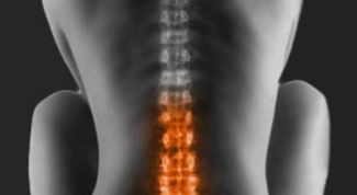 Картинка по теме - как лечить компрессионный перелом