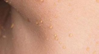 Картинка по теме - как избавиться от папиллом народными средствами