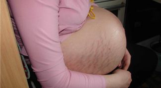 Картинка по теме - как убрать растяжки после беременности