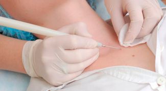 Картинка по теме - как удалить гемангиому