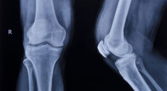 Картинка по теме - как лечить деформирующий артроз