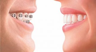 Картинка по теме - как исправить прикус