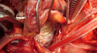 Картинка по теме - как лечить пролапс клапана