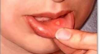 Картинка по теме - как лечить стоматит народными средствами