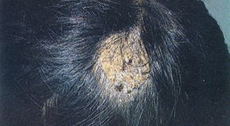 Картинка по теме - как лечить лишай в голове