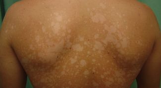 Картинка по теме - как распознать лишай у людей