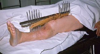 Картинка по теме - как избавиться от перелома