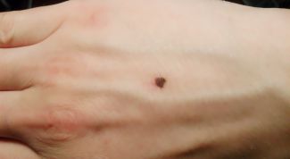 Картинка по теме - как удалить родинки народными средствами