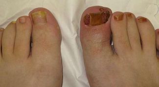 Картинка по теме - как свести ноготь