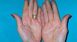 Картинка по теме - как лечить контактный дерматит