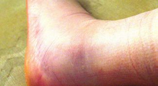 Картинка по теме - как лечить перелом лодыжки