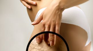 Картинка по теме - как убрать растяжки народные средства