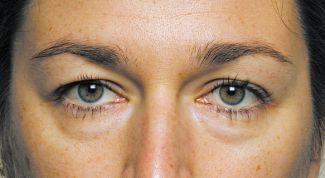 Картинка по теме - как лечить мешки под глазами